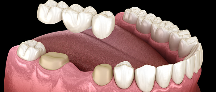 an animated image of fixed bridge teeth